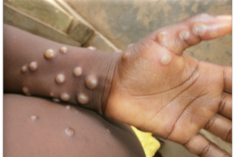 Angola’s Eastern Province Records 204 Mpox Cases